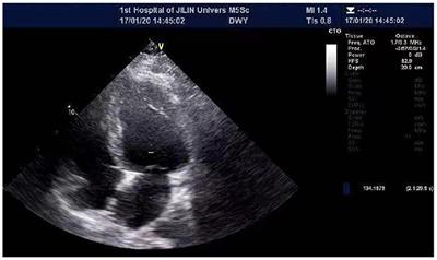 Duchenne muscular dystrophy involves the myocardium and causes arrhythmia: Case report